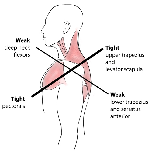 Upper-Crossed-Syndrome